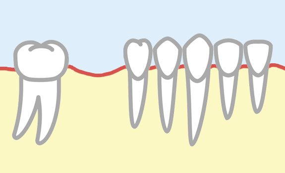 奥歯が1本抜けてしまった状態